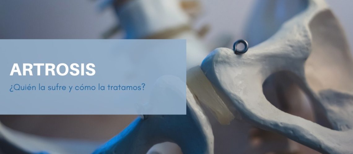 ARTROSIS ARTROSIS