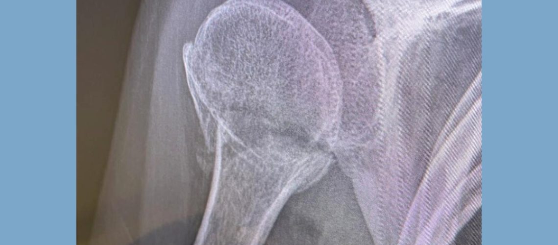 FRACTURA HÚMERO FRACTURA HÚMERO