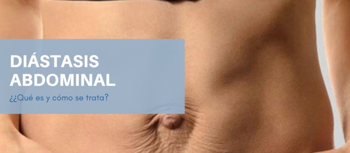 DIÁSTASIS ABDOMINAL