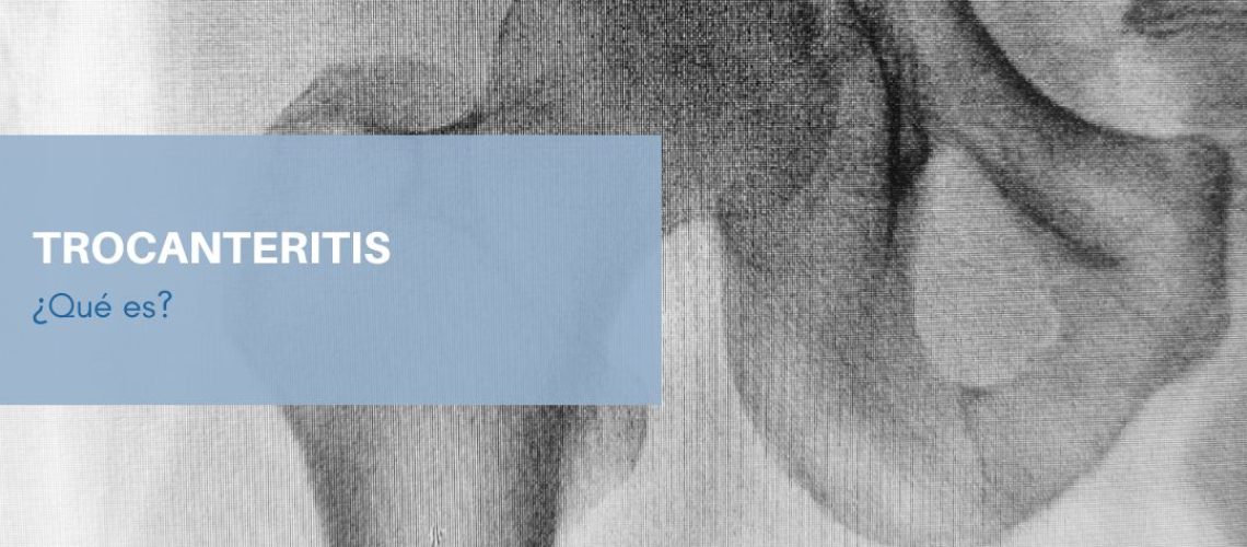 TROCANTERITIS