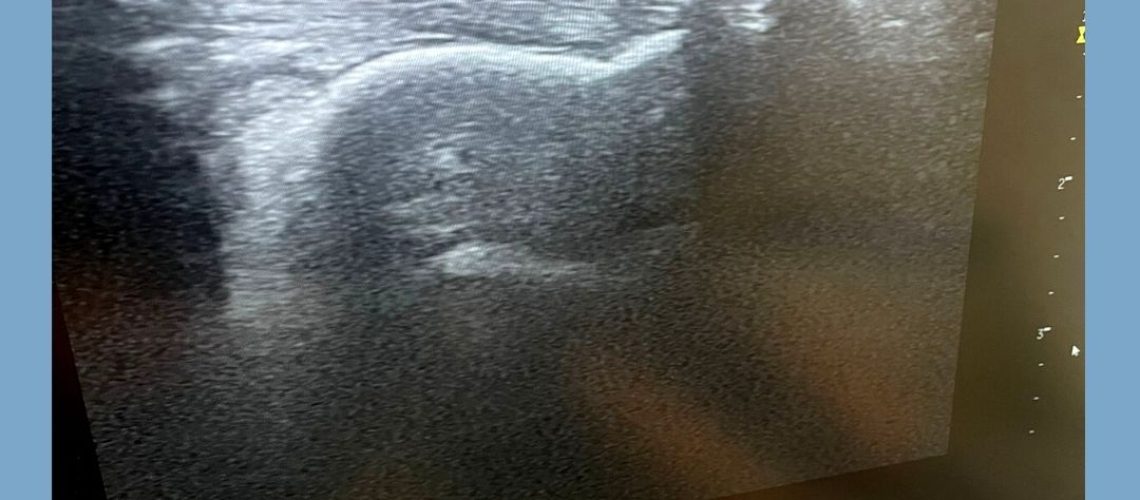 CALCIFICACIÓN TENDON AQUILES