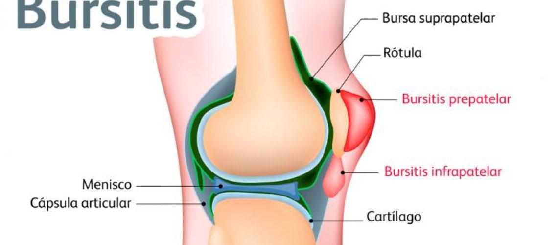 bursitis_infografia